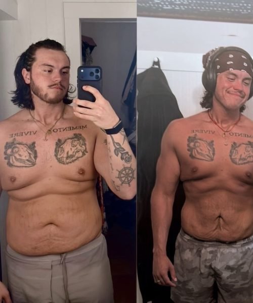 Before and after photos of a patient showing wellness progress (05)